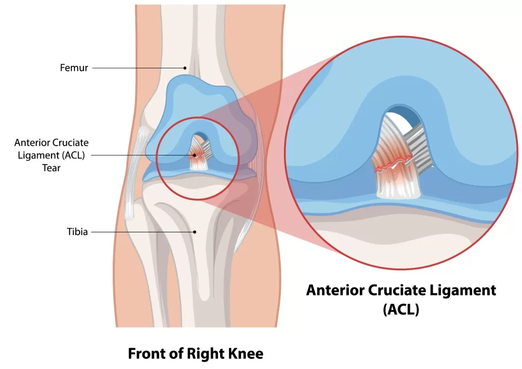 ACL tear diagram showing anterior cruciate ligament injury in the right knee treated with physiotherapy and sports rehabilitation.