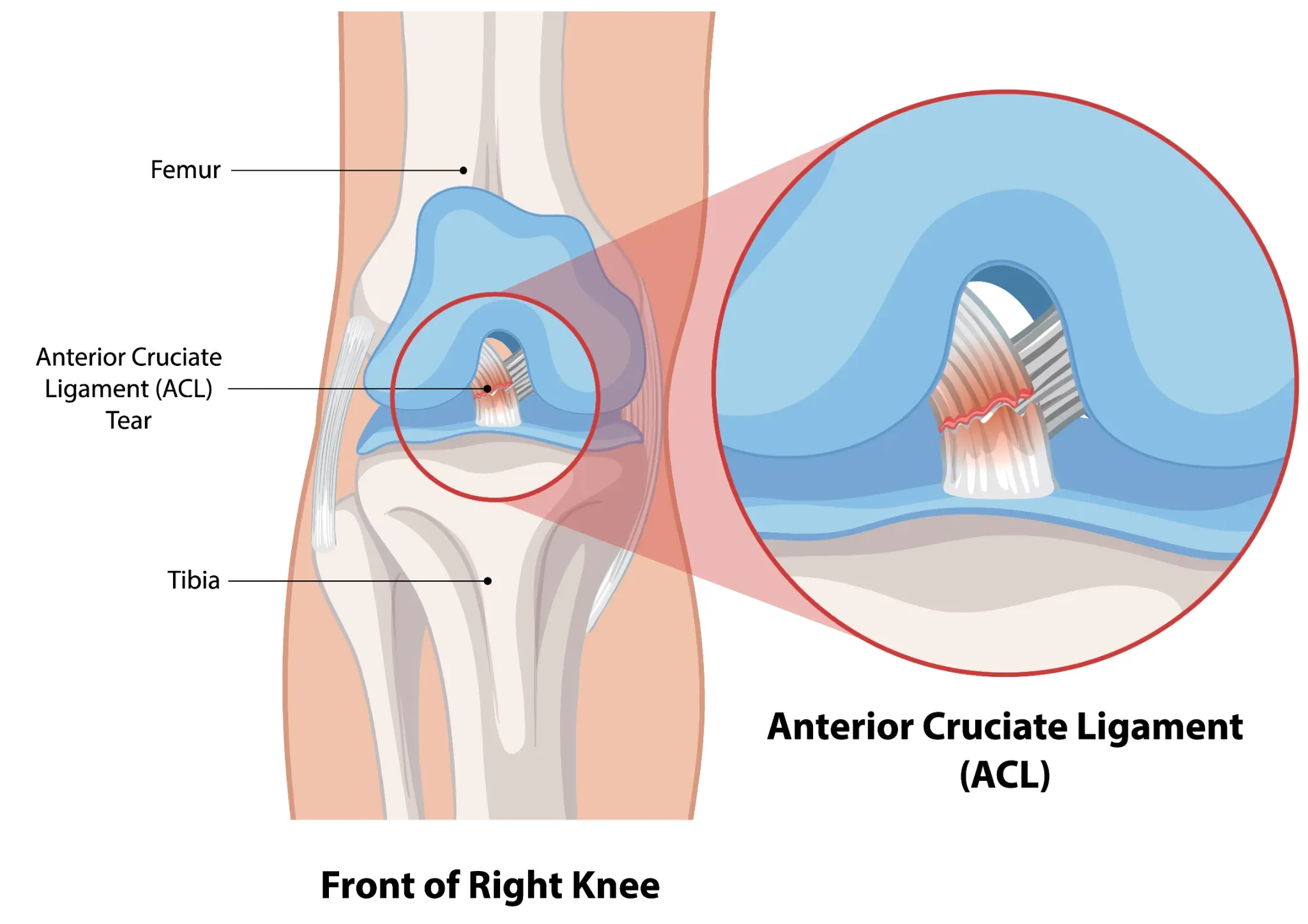 ACL tear diagram showing anterior cruciate ligament injury in the right knee treated with physiotherapy and sports rehabilitation.