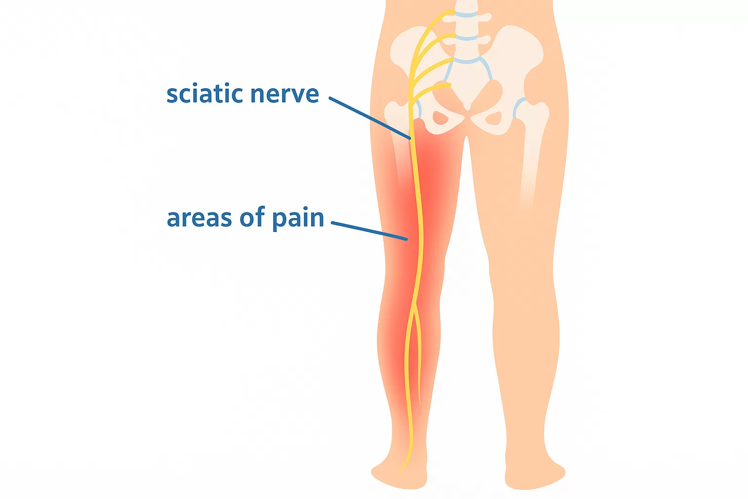 Diagram showing sciatic nerve and pain areas in the leg, illustrating nerve compression and pain pathway relieved through physiotherapy and targeted exercises.